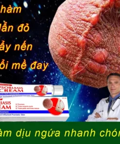 kem bôi nấm ngứa nhật bản bôi nấm ngứa vùng kín nam chống dị ứng khỏi tận gốc viêm da bệnh chàm Ngứa da nấm da nấm mụn n