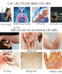 kem bôi nấm ngứa nhật bản bôi nấm ngứa vùng kín nam chống dị ứng khỏi tận gốc viêm da bệnh chàm Ngứa da nấm da nấm mụn n 15 nguanhat5
