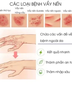 kem bôi nấm ngứa nhật bản bôi nấm ngứa vùng kín nam chống dị ứng khỏi tận gốc viêm da bệnh chàm Ngứa da nấm da nấm mụn n 17 nguanhat7