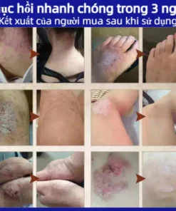 kem bôi nấm ngứa nhật bản bôi nấm ngứa vùng kín nam chống dị ứng khỏi tận gốc viêm da bệnh chàm Ngứa da nấm da nấm mụn n 19 nguanhat9