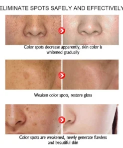Kem nám tàn nhang ,Kem xóa nám FRECKLE CREAM mờ nám tàn nhang đồi mồi dưỡng ẩm da phục hồi da chống lão hoá 14 fres9