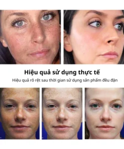 Kem nám tàn nhang ,Kem xóa nám FRECKLE CREAM mờ nám tàn nhang đồi mồi dưỡng ẩm da phục hồi da chống lão hoá 16 frewa5