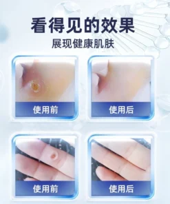 Alternative view of Serum bôi mụn cơm, chai chân, da dày, sần sùi, cước chân, da chết, từ thảo dược.