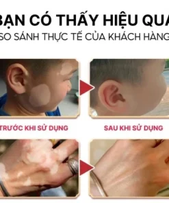 Kem Lang Ben TIANGE Hỗ Trợ Dứt Điểm Lang Ben, Bạch Biến, Chàm Da Hiệu Quả 13 tianlang4