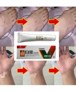 Kem Lang Ben TIANGE Hỗ Trợ Dứt Điểm Lang Ben, Bạch Biến, Chàm Da Hiệu Quả 14 tianlang5