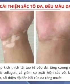 Kem Lang Ben TIANGE Hỗ Trợ Dứt Điểm Lang Ben, Bạch Biến, Chàm Da Hiệu Quả 17 tianna2