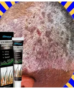 Alternative view of Kem bôi nấm loại bỏ vẩy nến, nấm da, hắc lào, á sừng, viêm da ngứa tay chân da đầu mông nấm Giảm ngứa hộp 20g