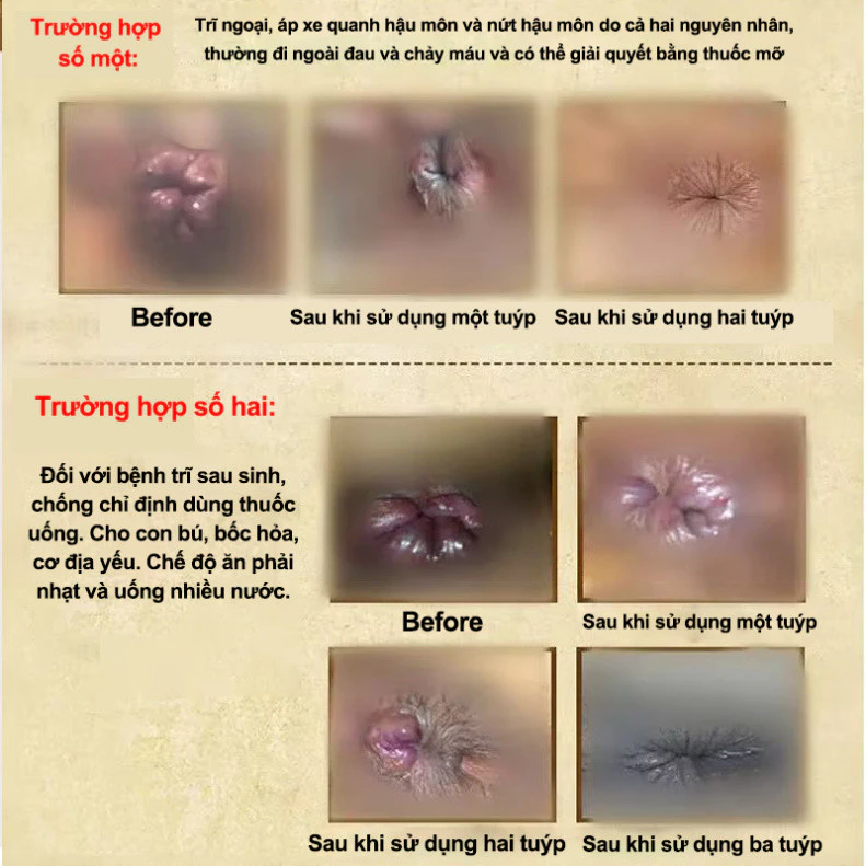 Kem bôi trĩ gel bôi trĩ Loại bỏ Trĩ hỗn hợp trĩ nội trĩ ngoại ngứa Đại tiện ra máu nứt hậu môn Giảm sưng 20g 18 boitro8