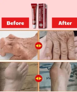 Gel giảm đau xương khớp - GEL THOÁT VỊ ĐĨA ĐỆM JINGUKANG 10 giamdau2 2