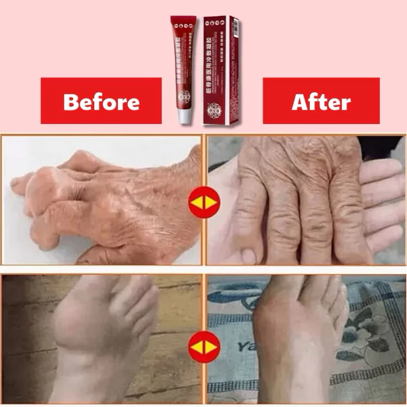 Gel giảm đau xương khớp - GEL THOÁT VỊ ĐĨA ĐỆM JINGUKANG 21 giamdau2 2