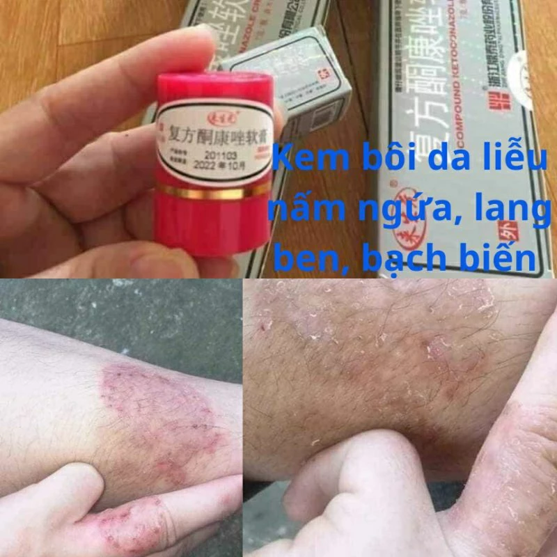 Kem bôi hắc lào, nấm ngứa, á sừng, lang ben, vẩy nến - Hàng sẵn 19 haclao4