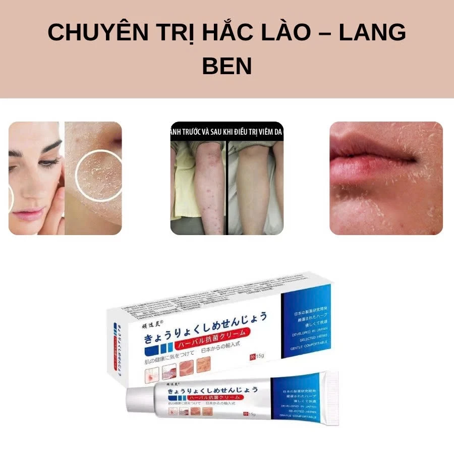 Kem Bôi Da Nhật Bản Chính Hãng – Dứt Điểm Nấm Ngứa, Hắc Lào, Nước Ăn Chân, Tổ Đỉa 2 Kem Bôi Da Nhật Bản Chính Hãng – Dứt Điểm Nấm Ngứa, Hắc Lào, Nước Ăn Chân, Tổ Đỉa - Ảnh 2