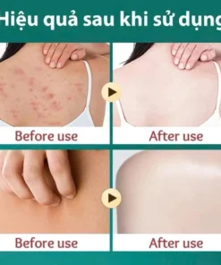 Kem Bôi Da Nhật Bản Chính Hãng – Dứt Điểm Nấm Ngứa, Hắc Lào, Nước Ăn Chân, Tổ Đỉa 13 kemnhat3