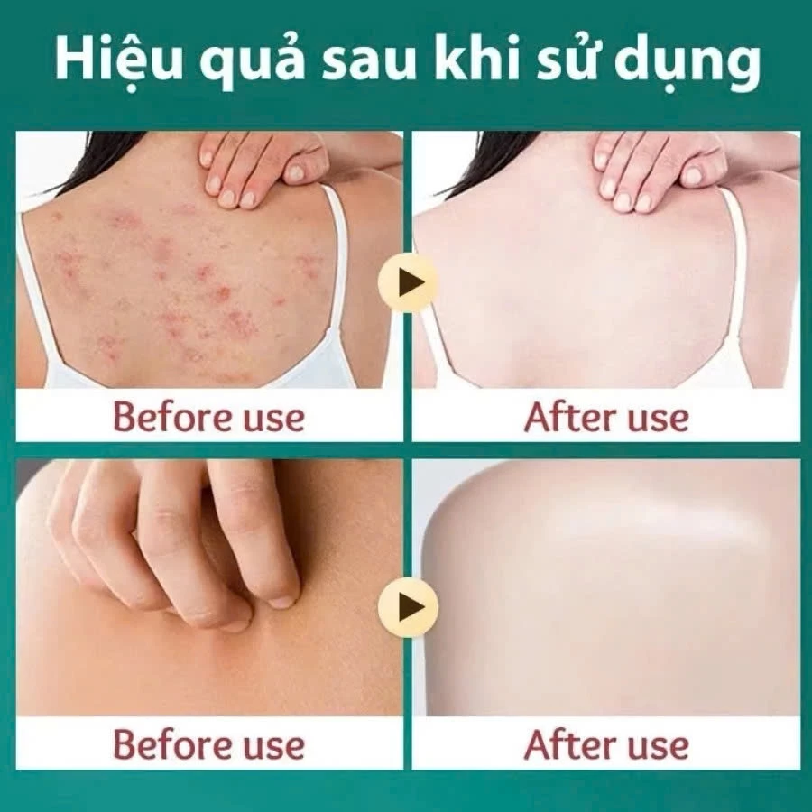 Kem Bôi Da Nhật Bản Chính Hãng – Dứt Điểm Nấm Ngứa, Hắc Lào, Nước Ăn Chân, Tổ Đỉa 22 kemnhat3