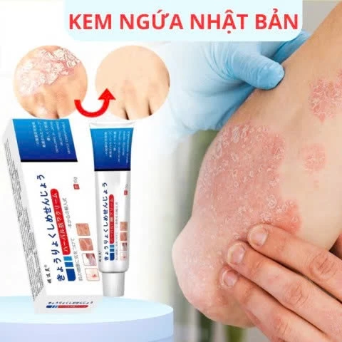 Kem Bôi Da Nhật Bản Chính Hãng – Dứt Điểm Nấm Ngứa, Hắc Lào, Nước Ăn Chân, Tổ Đỉa 18 kemnhat8