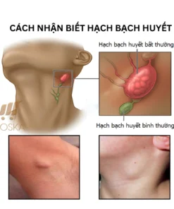 Kem Tan Hạch Cổ Truyền Nhật Bản, Teo U Hạch, Kem Mỡ Tiêu Tan Hạch Bạch Huyết 30g 13 kemtanhach3