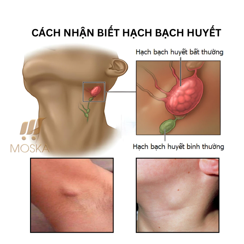 Kem Tan Hạch Cổ Truyền Nhật Bản, Teo U Hạch, Kem Mỡ Tiêu Tan Hạch Bạch Huyết 30g 21 kemtanhach3