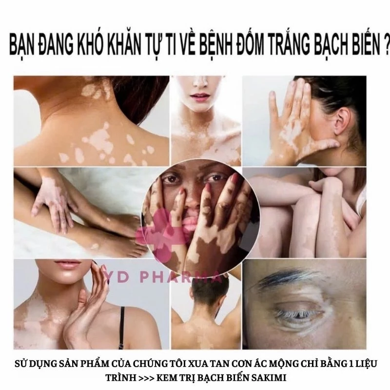 Kem bôi lang ben SAKIMI - Hỗ trợ cải thiện tình trạng lang ben, bạch biến trên da, đẩy lùi vi nấm - hủ 30G 21 sakimi2