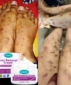 Alternative view of Kem LàM Mờ SẹO ThâM thâm sẹo do bị thương sẹo bỏng