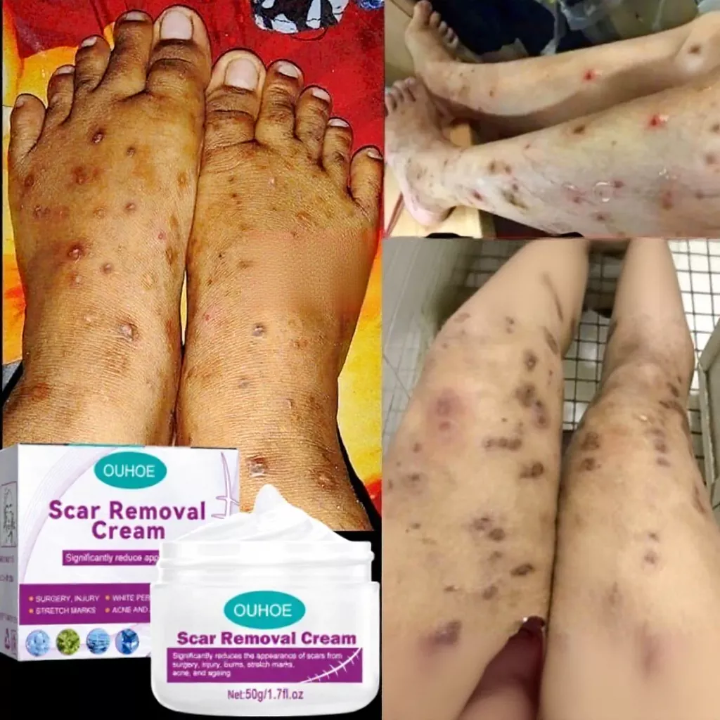 Kem LàM Mờ SẹO ThâM thâm sẹo do bị thương sẹo bỏng 22 seo1