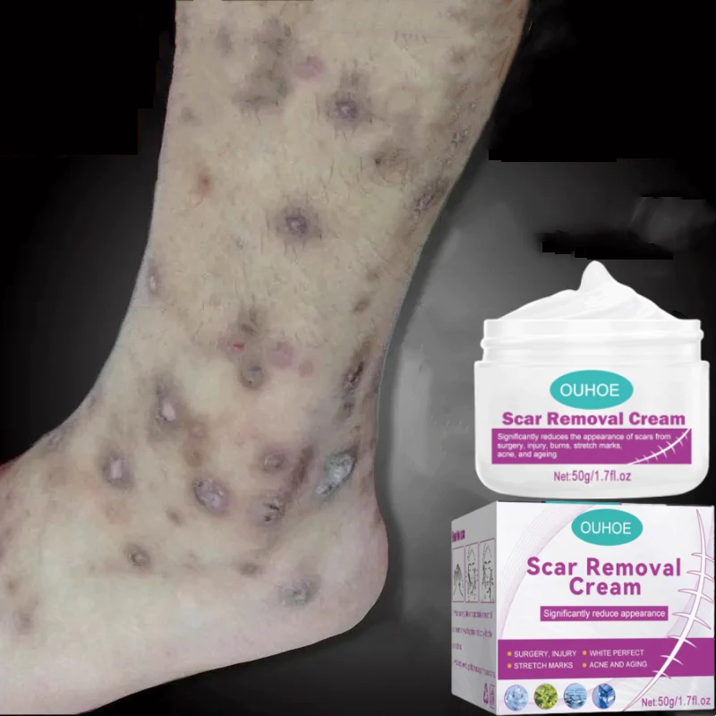 Kem LàM Mờ SẹO ThâM thâm sẹo do bị thương sẹo bỏng 21 seo2