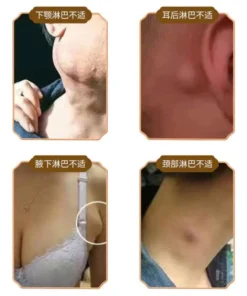 Kem Tan Hạch Bạch Huyết Nhật Bản - Hỗ Trợ Teo Hạch, Giảm Bướu Cổ - Tăng Cường Lưu Thông Mạch Máu 16 tanhach8