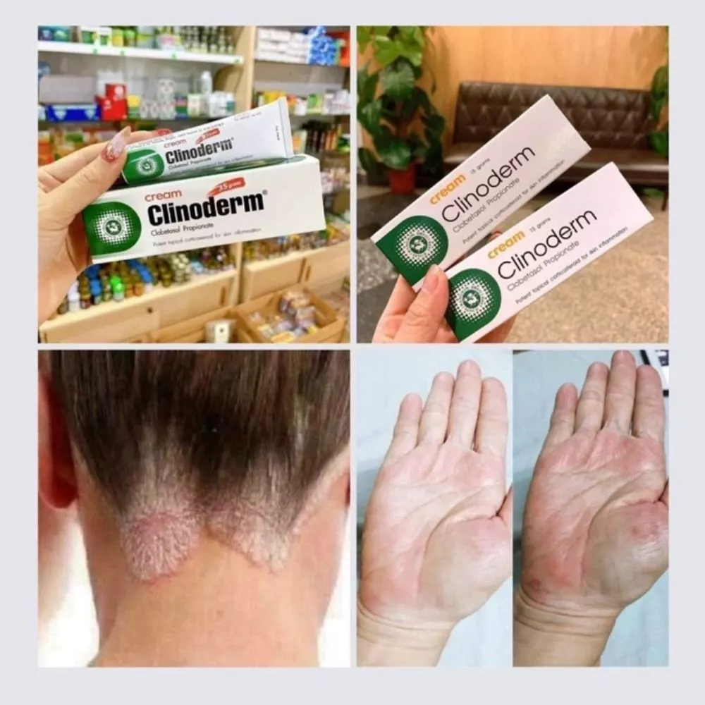 Kem Bôi Ngứa Vảy Nến Thái Lan Clinoderm Cream 15g Hỗ Trợ Viêm Da Cơ Địa, Tổ Đỉa, Nước Ăn Tay Chân 21 vaynen6