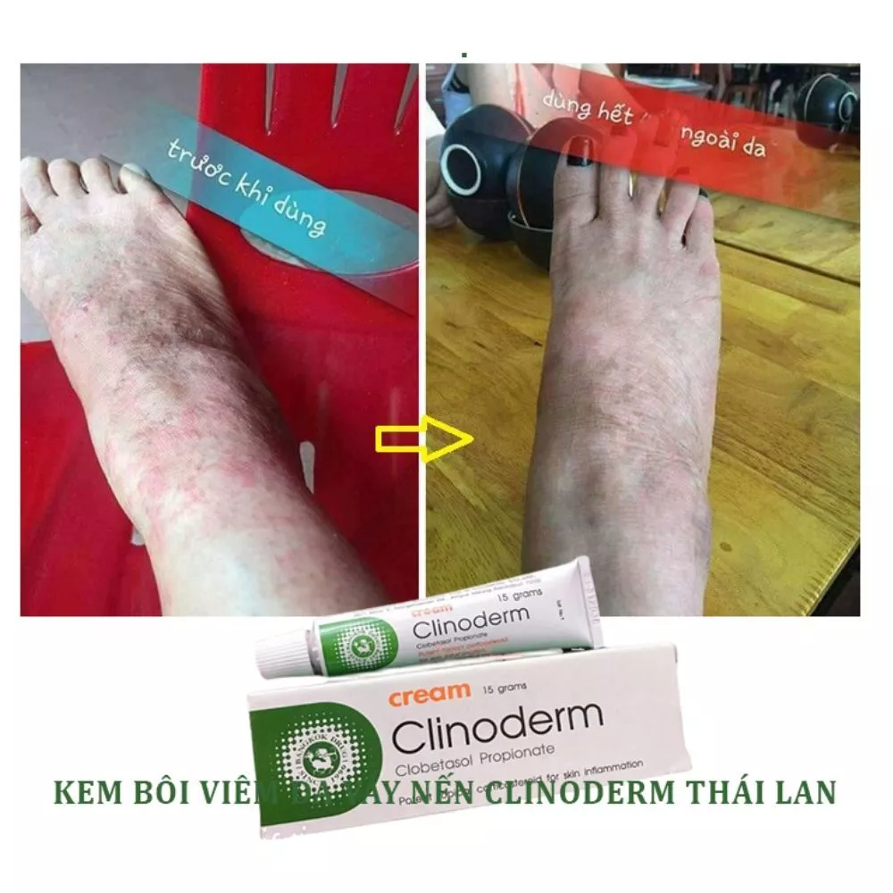 Kem Bôi Ngứa Vảy Nến Thái Lan Clinoderm Cream 15g Hỗ Trợ Viêm Da Cơ Địa, Tổ Đỉa, Nước Ăn Tay Chân 20 vaynen7