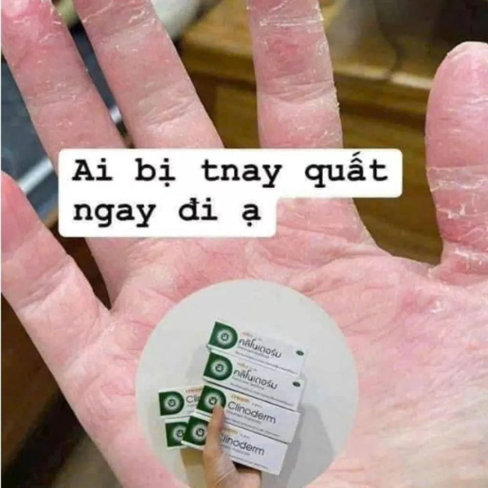 Kem Bôi Ngứa Vảy Nến Thái Lan Clinoderm Cream 15g Hỗ Trợ Viêm Da Cơ Địa, Tổ Đỉa, Nước Ăn Tay Chân 19 vaynen8