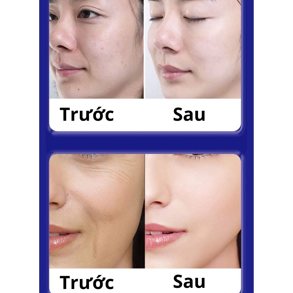 Kem UCM xóa nám, tàn nhang, trẻ hóa làn da Nội địa 16 xoanhan4 1