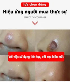 kem xóa sẹo loại bỏ hiệu quả các vết sẹo cũ sẹo phẫu thuật làm sáng các vết rạn da loại bỏ sẹo mụn trứng cá 12 xoaseo2