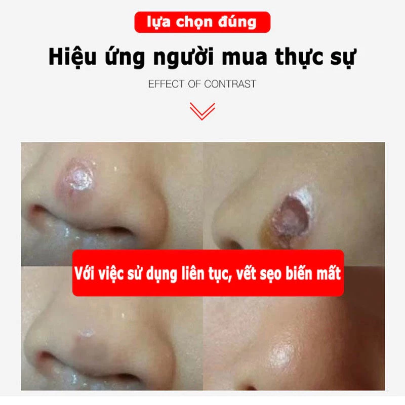 kem xóa sẹo loại bỏ hiệu quả các vết sẹo cũ sẹo phẫu thuật làm sáng các vết rạn da loại bỏ sẹo mụn trứng cá 27