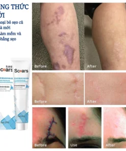 kem xóa sẹo loại bỏ hiệu quả các vết sẹo cũ sẹo phẫu thuật làm sáng các vết rạn da loại bỏ sẹo mụn trứng cá 13 xoaseo3