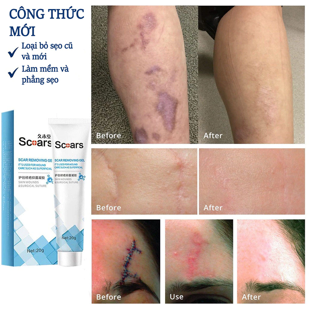kem xóa sẹo loại bỏ hiệu quả các vết sẹo cũ sẹo phẫu thuật làm sáng các vết rạn da loại bỏ sẹo mụn trứng cá 26
