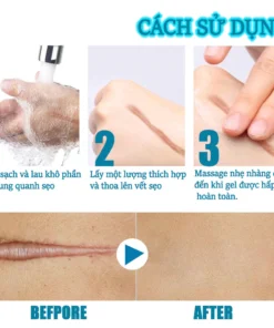 kem xóa sẹo loại bỏ hiệu quả các vết sẹo cũ sẹo phẫu thuật làm sáng các vết rạn da loại bỏ sẹo mụn trứng cá 15 xoaseo5