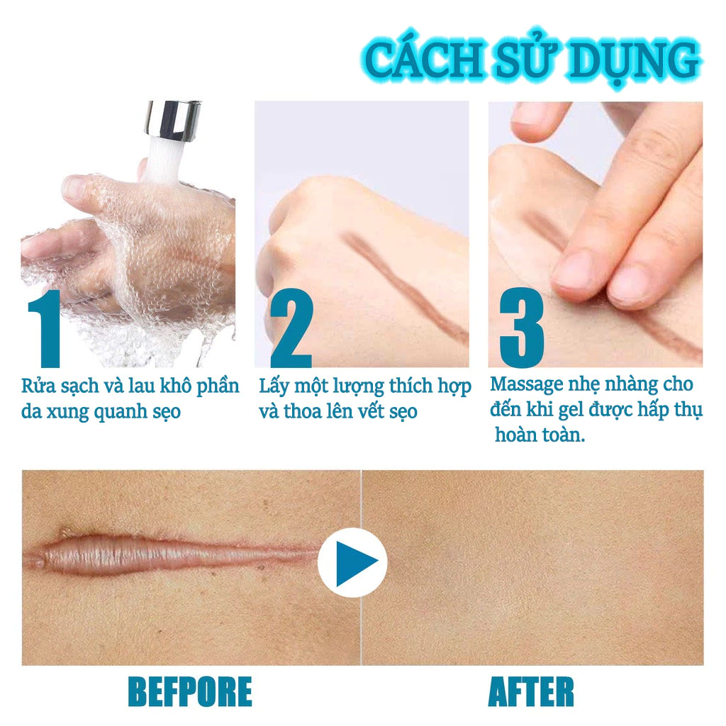 kem xóa sẹo loại bỏ hiệu quả các vết sẹo cũ sẹo phẫu thuật làm sáng các vết rạn da loại bỏ sẹo mụn trứng cá 24