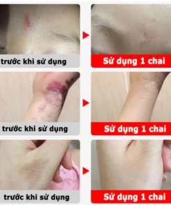 kem xóa sẹo loại bỏ hiệu quả các vết sẹo cũ sẹo phẫu thuật làm sáng các vết rạn da loại bỏ sẹo mụn trứng cá 17 xoaseo7