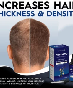 Serum, minoxidil minodry 5% mọc tóc, gãy dụng giảm dành cho người bị viêm tóc 12 mino3