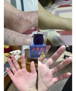 Kem Bôi Ngứa Xanh Lão Già ( Mẫu Mới ) 5 namxanh2