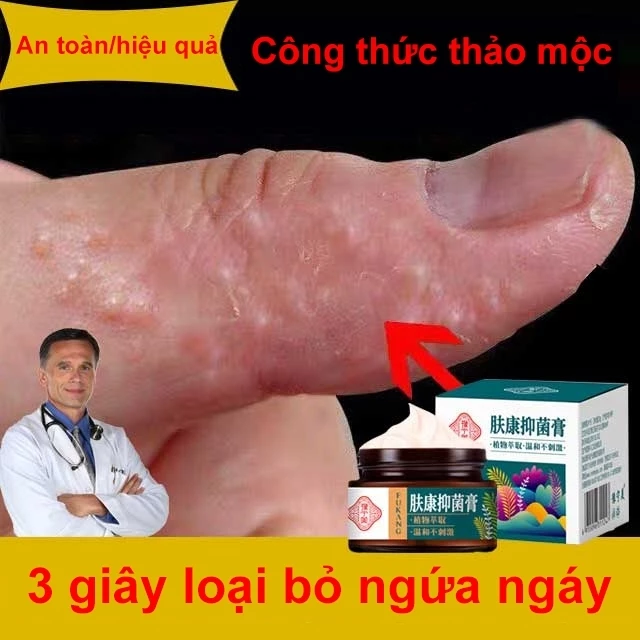 Kem chống ngứa kem kháng khuẩn chống dị ứng khỏi tận gốc viêm da bệnh chàm Ngứa da nấm da nấm mụn nước tổ đỉa 30g 28 ngua1 1