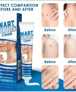 Kem Bôi Mụn Thịt Dư HBESTY WART REMOVER CREAM - Kem HBESTY Rụng Cồi Mụn, Rụng Mụn Thịt Dư, Không Đau Ngứa