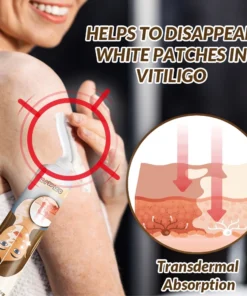 vitiligo6