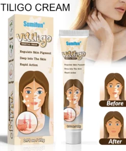 vitoligo3