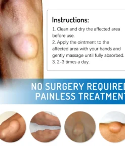 South Moon 20g Kem tan u mỡ Lipoma Lipolysis cho sưng da và u 13 kem4