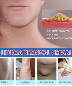 lipoma6