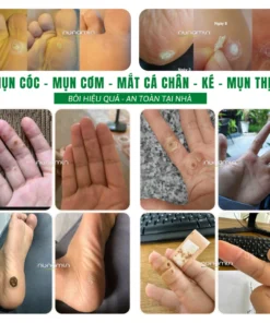 Alternative view of Tinh Chất Chấm Rụng Mụn Cóc, Mụn Cơm, Mụn Thịt, Mắt Cá Chân Lâu Năm