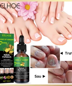 TINH CHẤT LOẠI BỎ NẤM MÓNG CHÂN TAY GINGER EELHOE 7 NGÀY 50ML, SERUM XỬ LÍ TRIỆT ĐỂ NẤM MÓNG, THỐI MÓNG