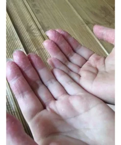 Kem thảo dược bôi viêm da cớ địa nấm ngứa vẩy nến á sừng 9 kemboinhat3