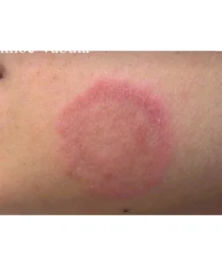 Kem thảo dược bôi viêm da cớ địa nấm ngứa vẩy nến á sừng 10 kemboinhat4