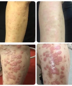 Kem thảo dược bôi viêm da cớ địa nấm ngứa vẩy nến á sừng 12 kemboinhat6